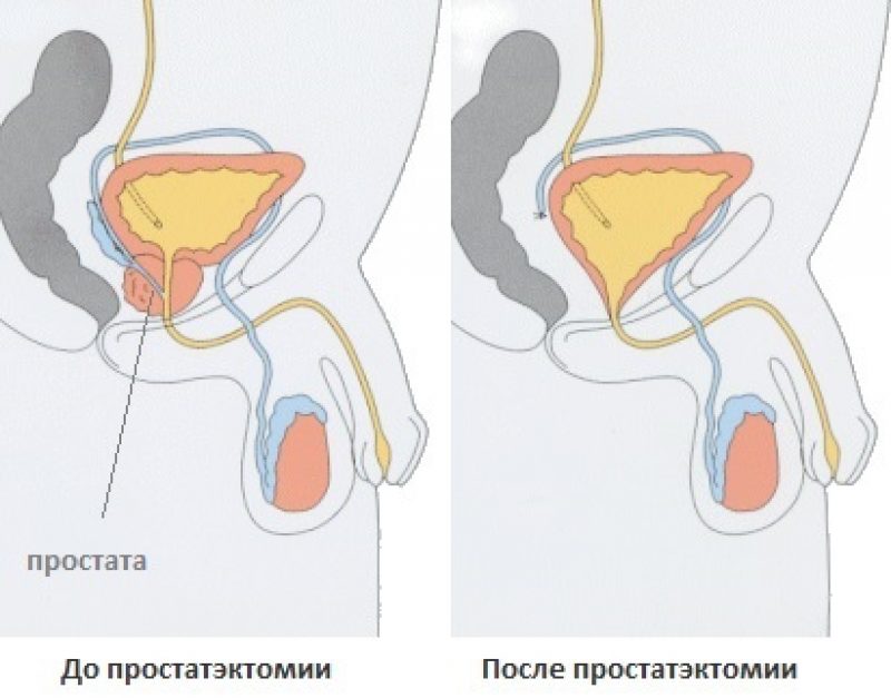 Боровая матка от простатита отзывы
